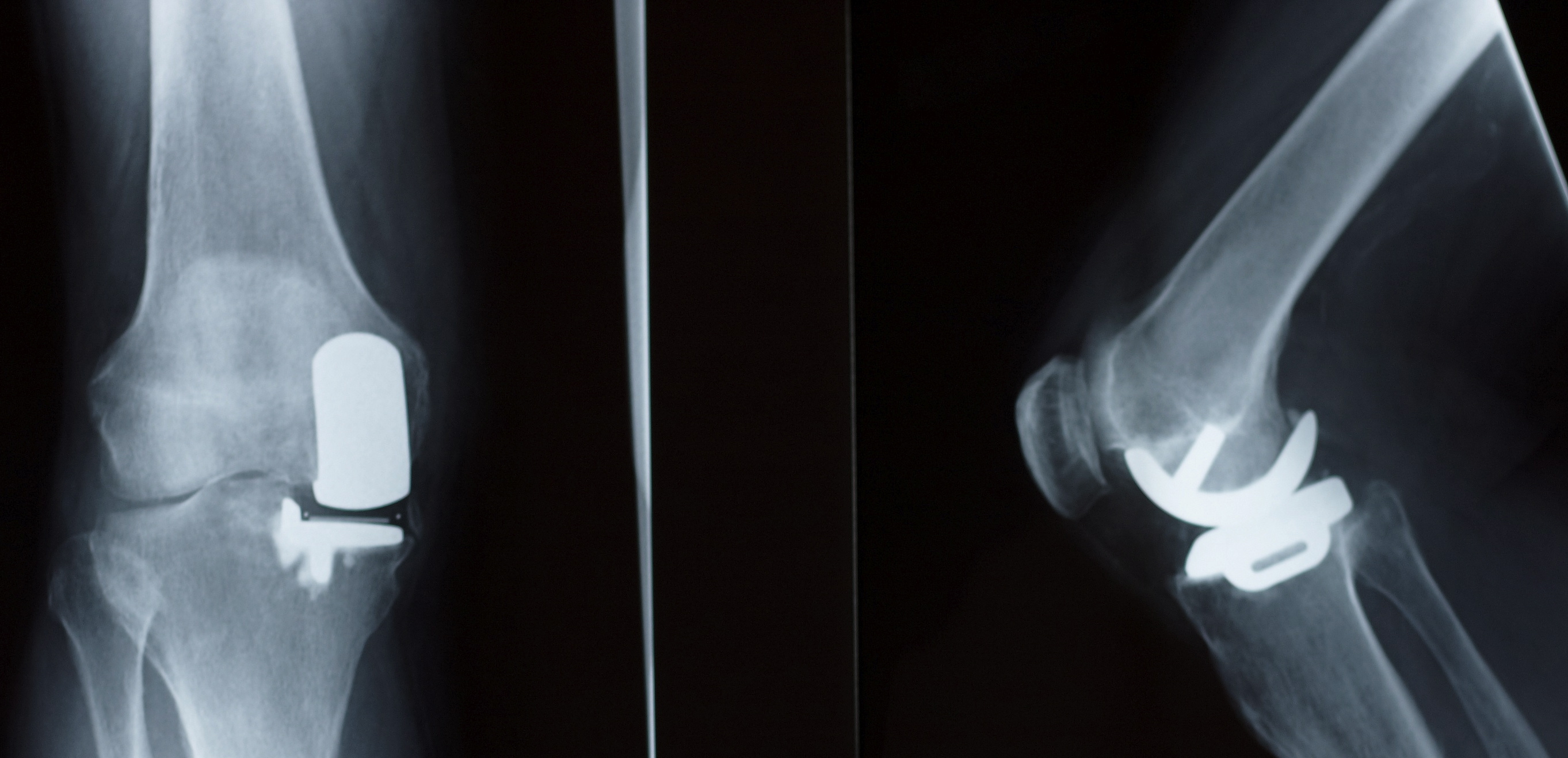 robotic-partial-knee-replacement-prestige-sports-medicine